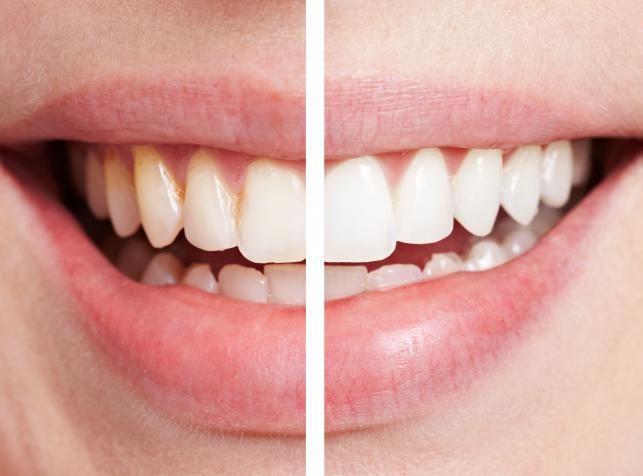 Wybielanie zębów – nowa, autorska metoda lekarzy z Katowic
