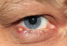 Jak lekarz stwierdza zapalenie ucha?